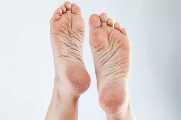 تصویر 5 از خرید و فروش پماد ترک پا با شرایط فوق العاده